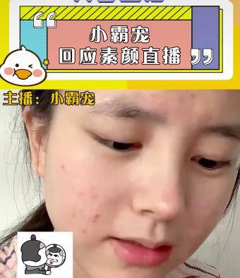 化妆品小霸宠首次透露素颜直播原因，审美跟大家不同，觉得满脸痘很好看