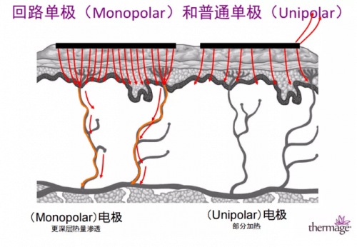 能量|热玛吉抗衰天花板，为何无法超越？