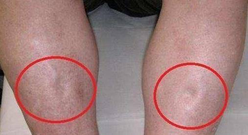 症状|4种人易患尿毒症，4个早期症状，平时留心易发现，早知早受益！