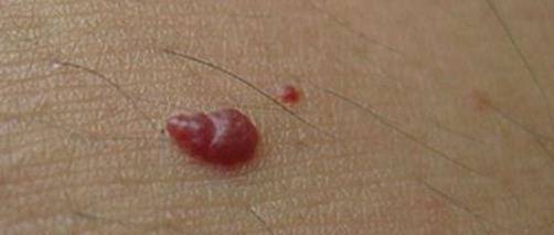 症状|46岁男子查出肝硬化，因为3个信号都被忽视了，早发现早治疗