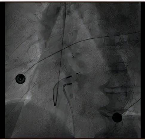 技术|心乱如麻 何以解忧—— 我院临时起搏器+希氏束起搏手术成功实施