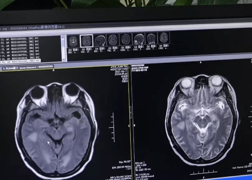 球菌|女子帮丈夫杀鸡后失去意识，险些丧命！医生：这病致死率高达40%