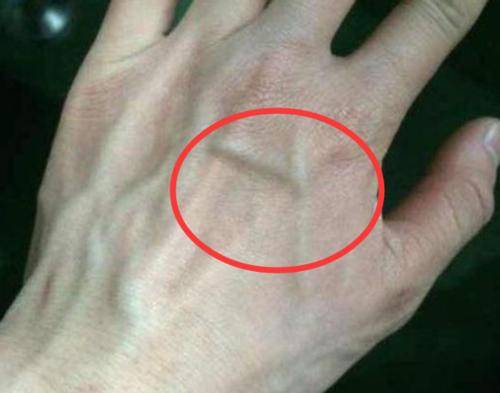 肝脏|肝好的人，看手“先知晓”？医生：手上有4个“迹象”，说明肝不错