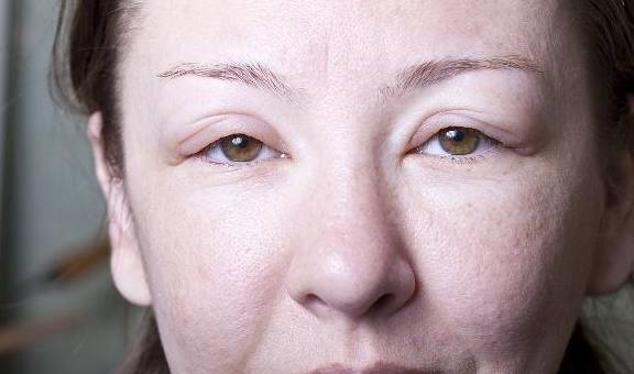 尿酸|尿酸高的人，身体若有这3个“变化”，可能已经“连累”到肾脏了