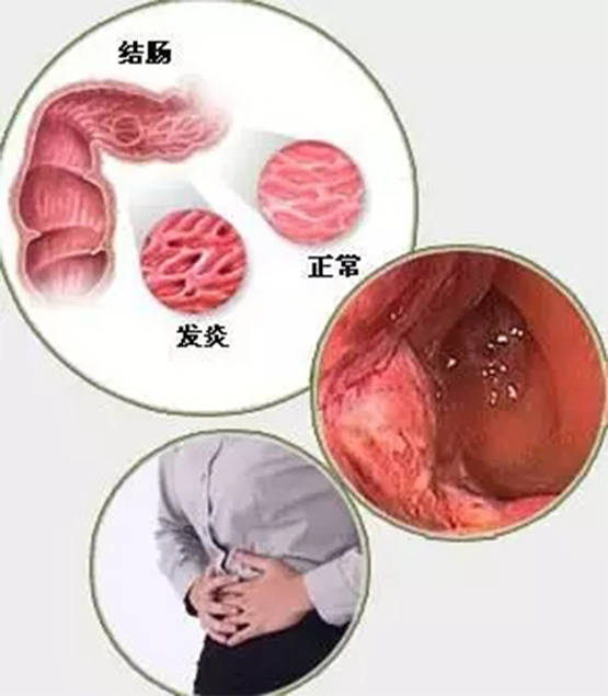 克羅恩病和潰瘍性結腸炎到底怎麼區分