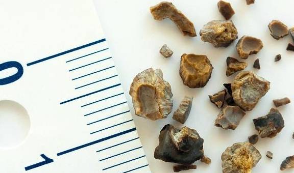 肾脏|哪些人群最容易患上肾结石？高浓度的尿酸通过肾脏，会导致什么？