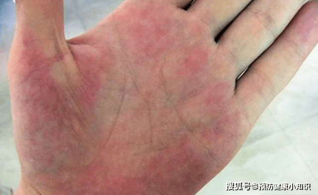 肝脏|肝癌早期不痛不痒，若出现“2黄1红”，别拖了，早检查肝CT