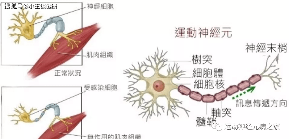 饮食|运动神经元病治疗（饮食篇）