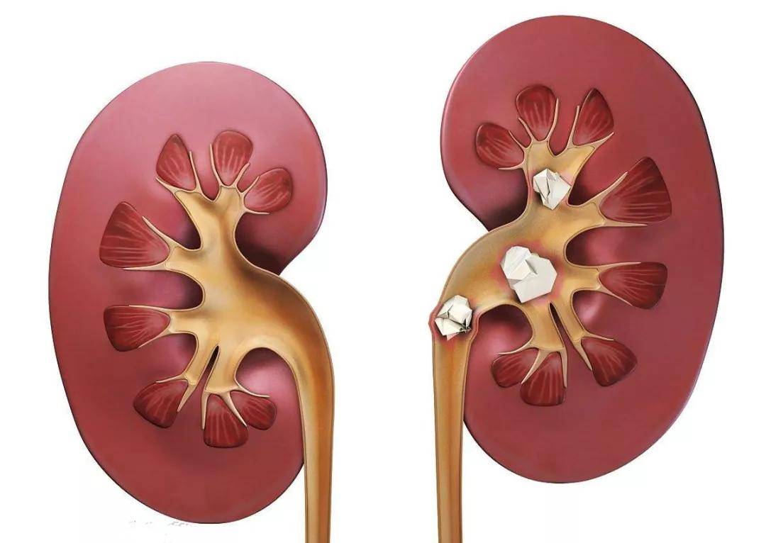 症状|肾结石疼痛, 3招让您快速缓解疼痛!