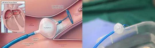 成功|西安市第三医院心内三病区成功开展首例房颤冷冻消融术