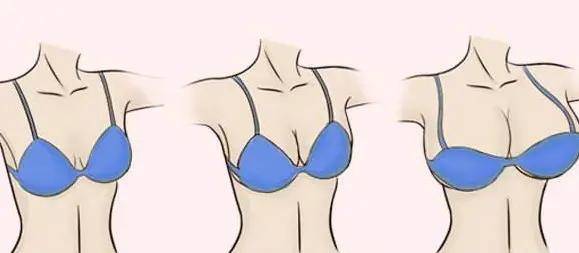 效果|自体脂肪丰胸贺天遥指出自体脂肪丰胸术后护理很重要