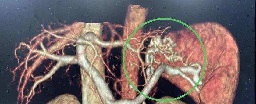 脾脏|70岁老太太吐血1.3升，胃镜检查却发现和肝有关，严重时危及生命