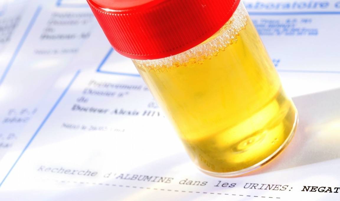 相关|尿检查出潜血而且有3个加号,是什么原因?今天,来告诉各位答案