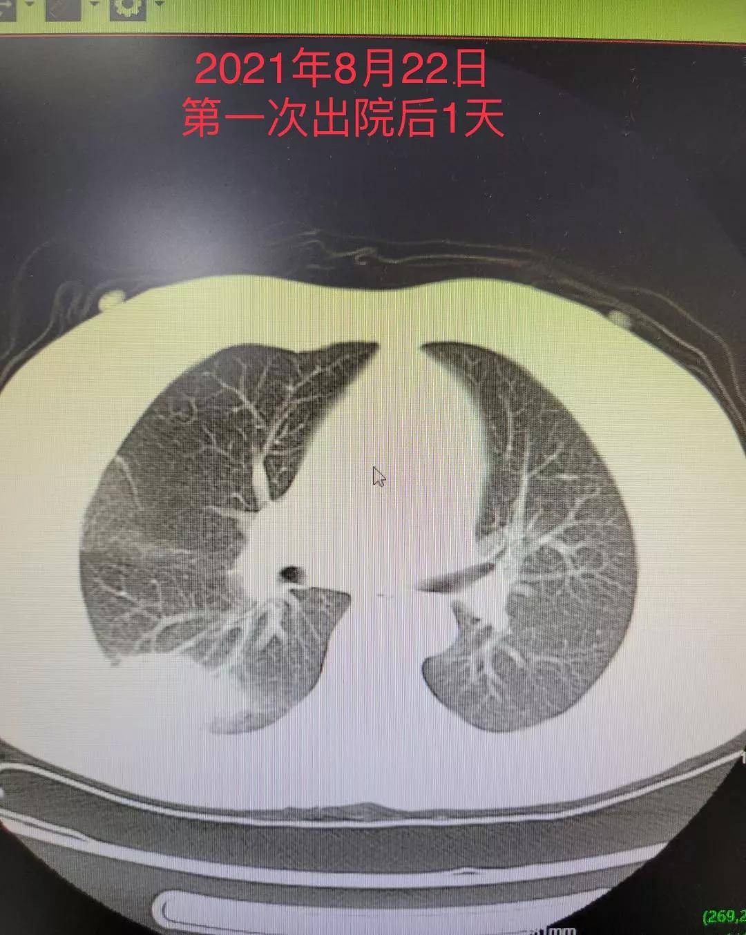 病例】绵阳富临医院呼吸与危重症医学科成功救治一例鹦鹉热衣原体肺炎