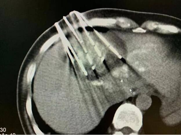 癌症|湖北肿瘤医院选择广州复大肿瘤医院：肝癌患者致谢复大