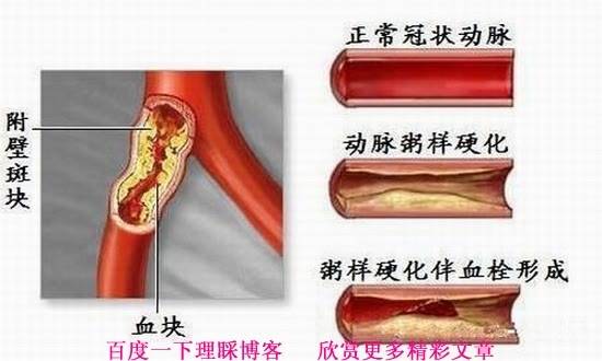 血管堵塞时你有感觉没?_血液