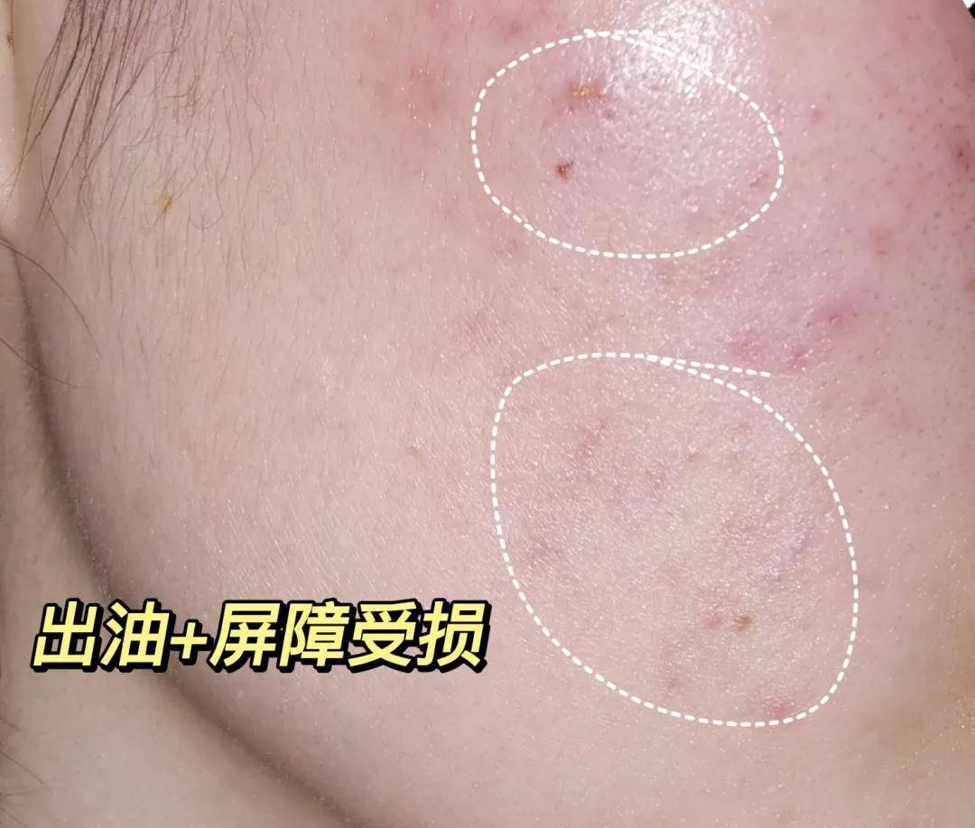 祛痘快速祛痘方法：油皮，痘痘肌该怎么护肤控油祛痘