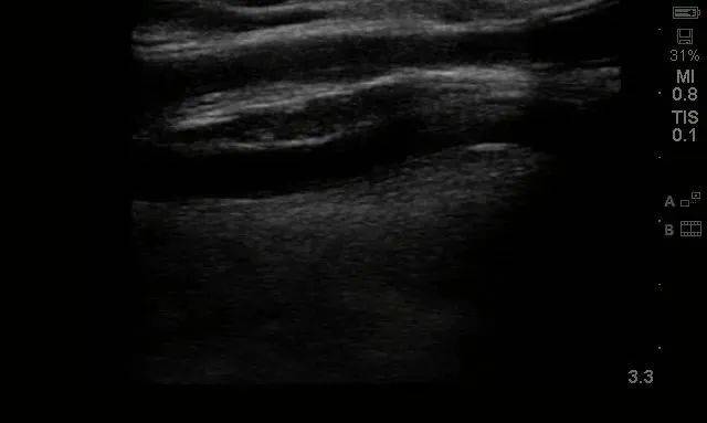 惠州|肾友的“透析生命线”堵了！关键时刻，一个电话解决了大难题