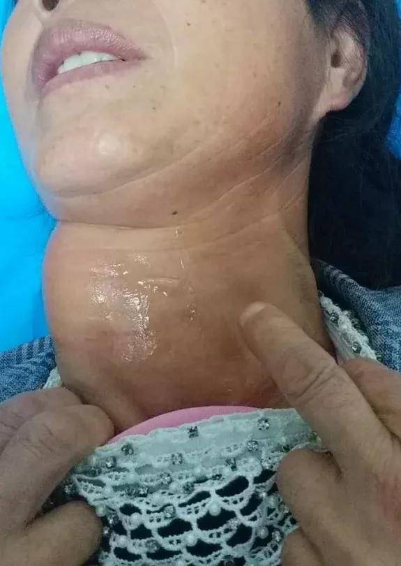 食管|张先慧主任分享:让甲状腺疾病治疗更高效,更精准!