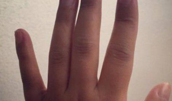 毒素|“糖尿病”患者3个表现，或许是走向“尿毒症”的信号，早知早好