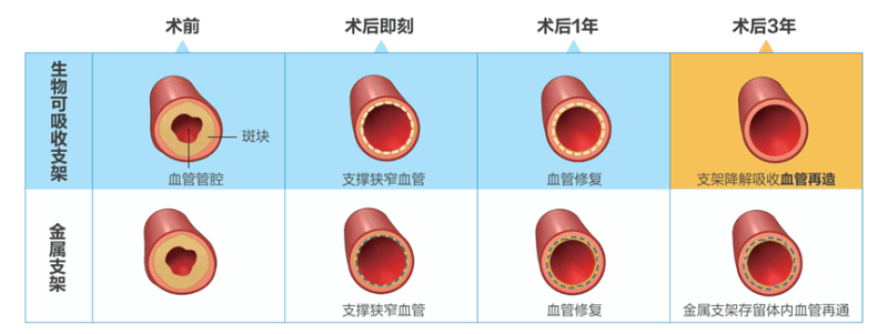 血管|全降解支架：创新产品呵护冠心病患者健康