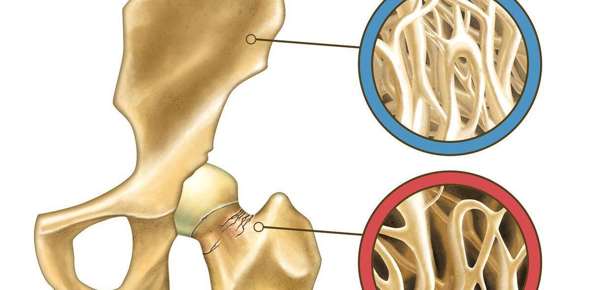骨质疏松多久能见效果 b80678916eba4844a39914ea581d6ca5.jpeg