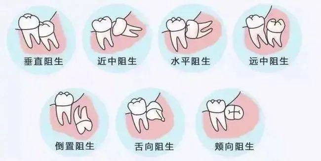 妙手|智齿牙根弯曲紧贴神经管，医生妙手微创拔除