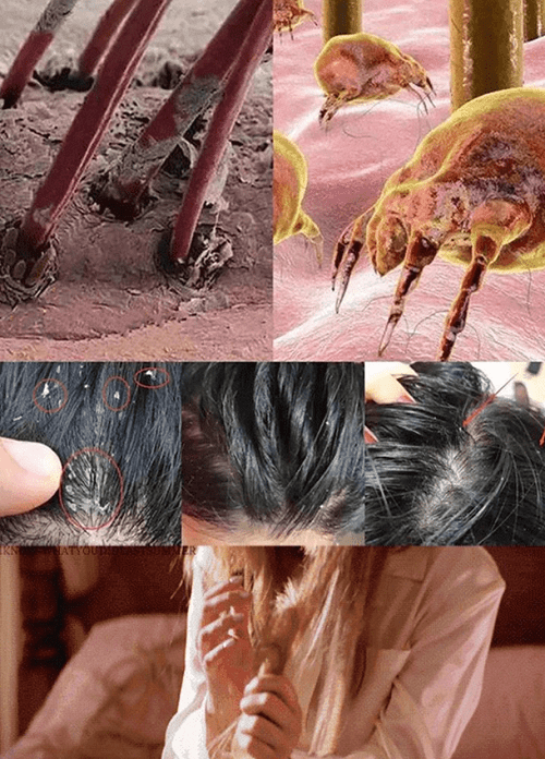 舒蕾替你解决头螨带来的烦恼