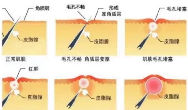 汗孔关于皮肤的基础知识