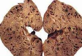 肾脏|老刘查出“肾衰竭”，医生说：要不是这些症状，你可能活不过明年