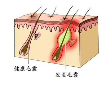 培育良好的頭皮環境也是頭髮健康生長的必要條件,為什麼這樣說呢,這裡