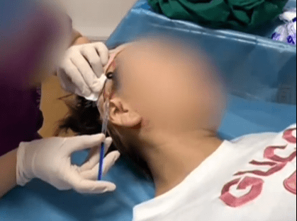 因为女子花1万元做拉皮手术导致面瘫,操刀人曾两次因非法行医被罚