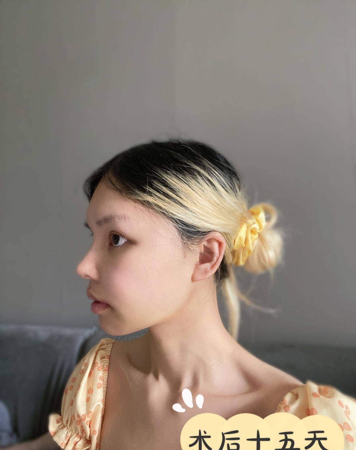 设计做下颌角到底留角or不留角？