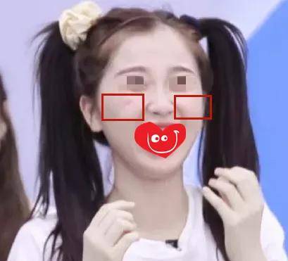 颧骨拉垮颜值的“印第安纹”，终于找上了95后
