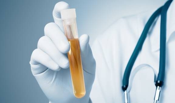 蛋白尿|尿常规结果波动比较大，我们怎样确定自己是否存在蛋白尿？