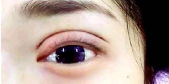 眼睛双眼皮手术后，我经历了半个月的焦虑……有没有同样感受的？