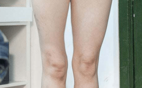 索和|重症肌无力和渐冻症的区别