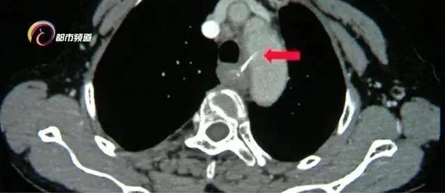 女士|警惕！鱼刺卡喉险丧命？就是因为用了这个“土办法”……