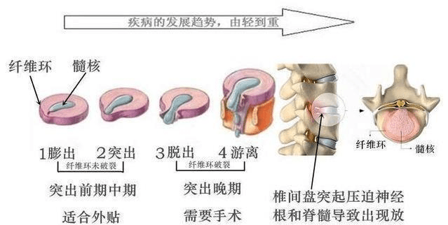 癥狀|不手術治療腰間盤突出新方法