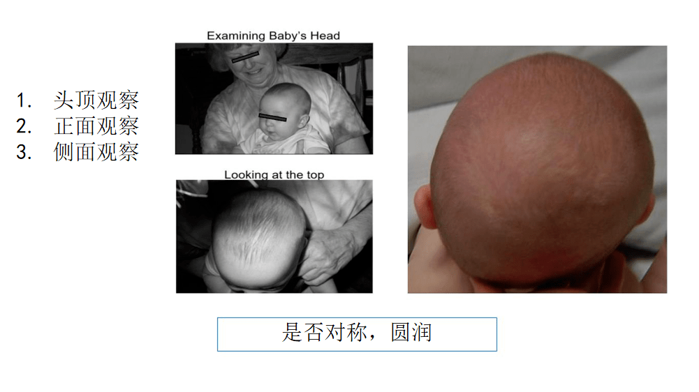 适用于3-18个月患有中度至重度体位性的头颅畸形的婴儿,包括婴儿斜头