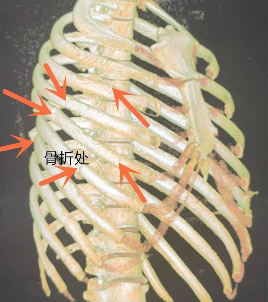 咸阳市第一人民医院 微创治愈肋骨骨折赢赞誉 手术