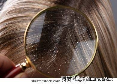 洗头头屑、头油，怎么调理才能搞定？试试这些方法！