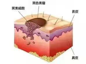 or|血栓外痔or肛管直肠黑色素瘤? 别傻傻分不清