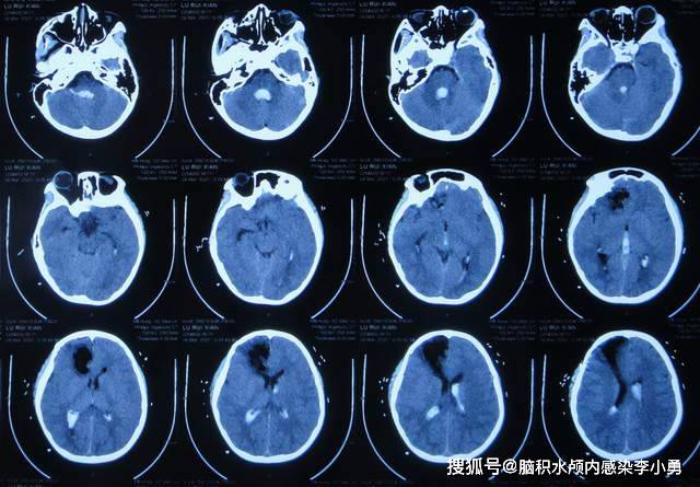 大池|7岁儿童脑出血后脑积水，腰大池引流术后加重感染，顽固性持续发热30余天