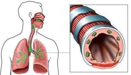 症状|支气管扩张很可怕?做好这几点,要你长寿