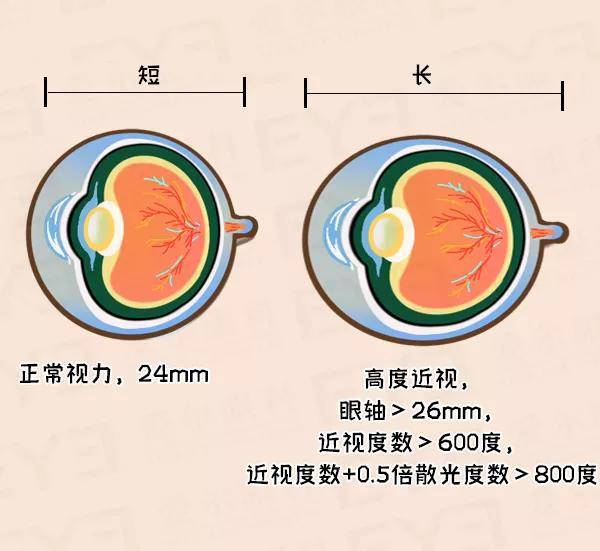 植入术|近视＞600度的人，必看！！！