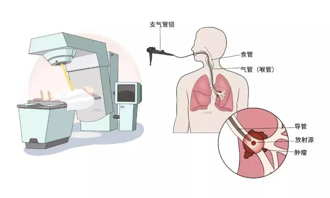 支氣管鏡檢查是將細長的支氣管鏡經鼻或口腔插入患者的氣管或支氣管