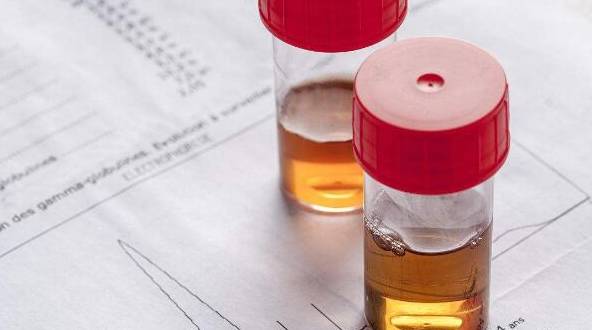 治疗|肾病医生：治疗尿蛋白，激素如何减量才好？还要注意什么？