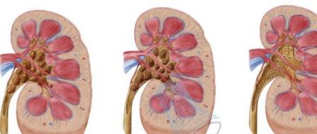 肾脏|这5种“高草酸钙”的食物，日常生活中尽量不要多吃，避免肾结石