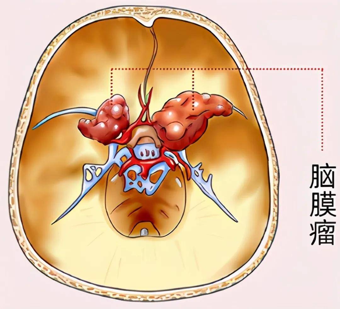 脑膜瘤